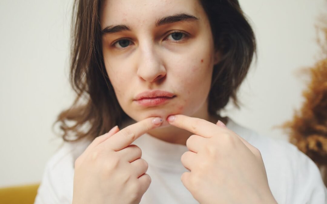 Adult Acne in Ottawa: Why 1 in 5 Women Experience Breakouts After Their Teens