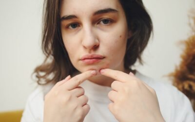 Adult Acne in Ottawa: Why 1 in 5 Women Experience Breakouts After Their Teens